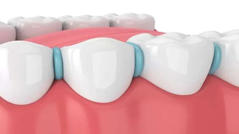 Spacers for Teeth: How Spacers for Teeth Can Give You the Best Smile